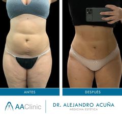 Liposucción - AA CLINIC