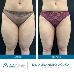 Liposucción - AA CLINIC