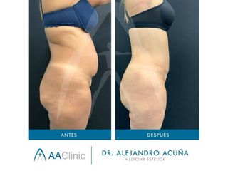 Liposucción - AA CLINIC
