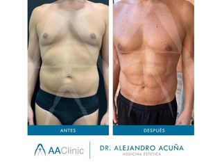 Marcación abdominal - AA CLINIC