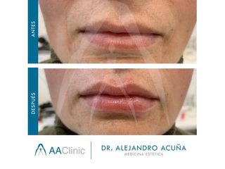 Aumento de labios - AA CLINIC