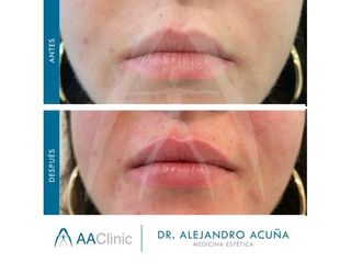 Aumento de labios - AA CLINIC