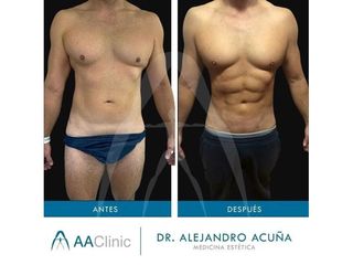 Marcación Abdominal - AA CLINIC