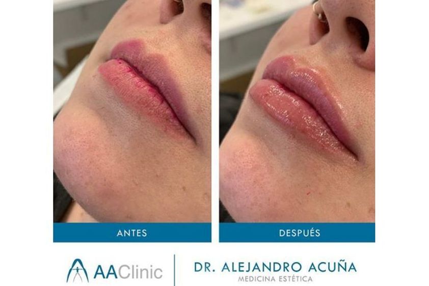 Aumento labios antes y después - 775883