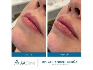 Aumento de labios - AA CLINIC