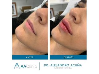 Aumento de labios - AA CLINIC