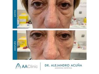 Eliminación de ojeras - AA CLINIC