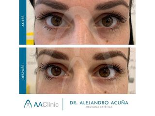 Eliminación de ojeras - AA CLINIC