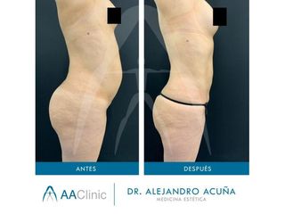 Abdominoplastia - AA CLINIC