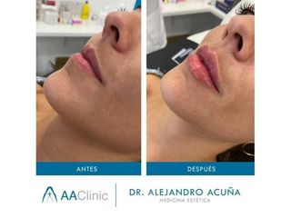 Aumento de labios - AA CLINIC