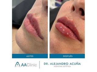 Aumento de labios - AA CLINIC