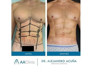 Marcación abdominal - AA CLINIC
