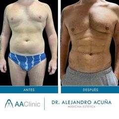 Marcación abdominal - AA CLINIC