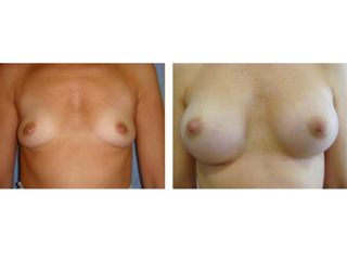 Antes y después Corrección de pezones invertidos