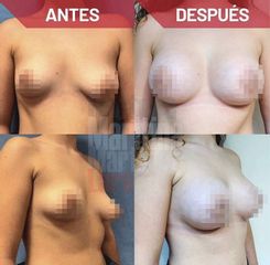 Aumento mamario