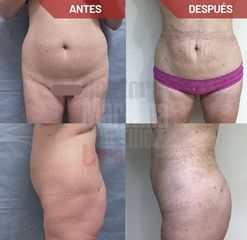 Modelado de glúteos, abdomen, costado y cartucheras