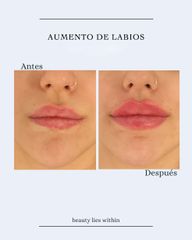 Aumento de labios - Clínicas Vieco