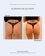 Aumento glúteos - Clínicas Vieco