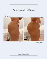 Aumento glúteos - Clínicas Vieco