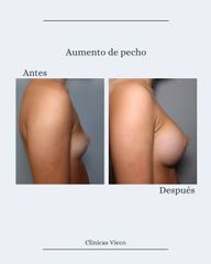 Aumento de pecho - Clínicas Vieco