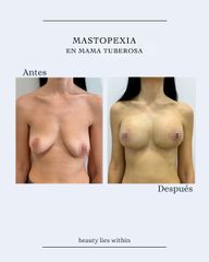 Mastopexia - Clínicas Vieco
