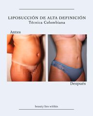 Lipotransferencia glútea - Clínicas Vieco