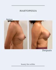 Mastopexia - Clínicas Vieco