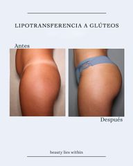 Lipotransferencia glútea - Clínicas Vieco