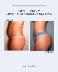 Lipotransferencia glútea - Clínicas Vieco