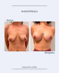 Mastopexia - Clínicas Vieco