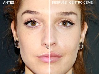 Antes y después Aumento de labios