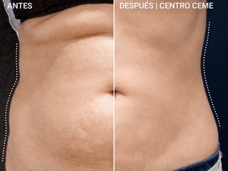Antes y Después Liposucción