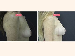 Antes y después pecho