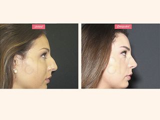 Antes y después rinoplastia