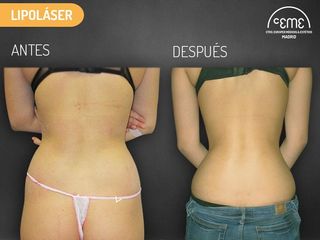 Antes y Después AYD lipolaser