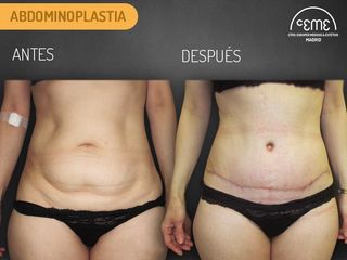 Antes y Después Adominoplastia