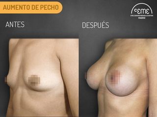 Antes y Después aumento de pecho 