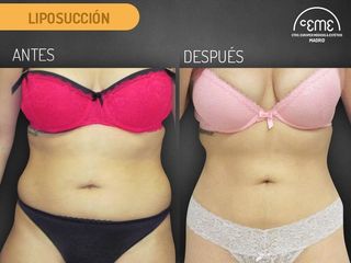 Antes y Después Liposución