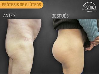 Aumento glúteos - 636040