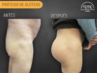 Antes y Después PRÓTESIS DE GLÚTEOS