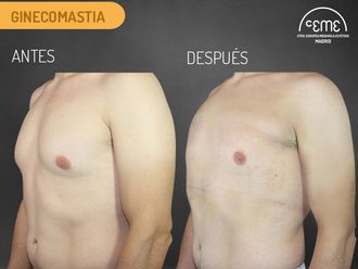 Ginecomastia - 636042