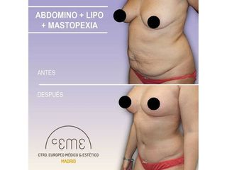 Antes y después Abdominoplastia - Centro CEME