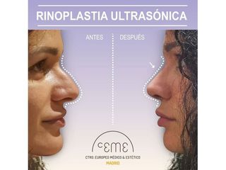 Antes y después Rinoplastia - Centro CEME