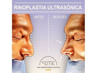 Antes y después Rinoplastia - Centro CEME
