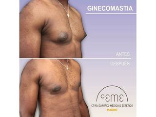 Antes y después Ginecomastia - Centro CEME