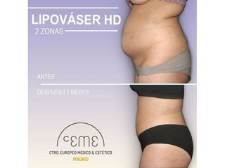 Antes y después Lipo vaser - Centro CEME