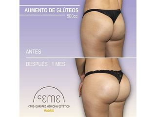 Antes y después Aumento de glúteos - Centro CEME