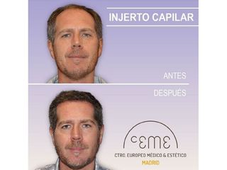 Antes y después Injerto capilar - Centro CEME