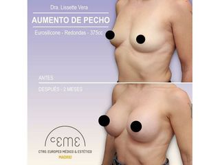 Antes y después Aumento de pecho - Centro CEME