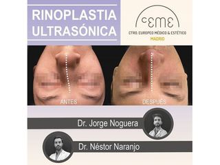 Antes y después Rinoplastia - Centro CEME
